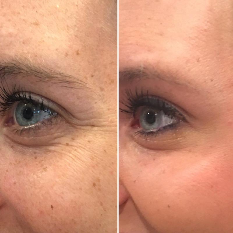 Botox + Exilis combination result — Bella Luce Med Spa