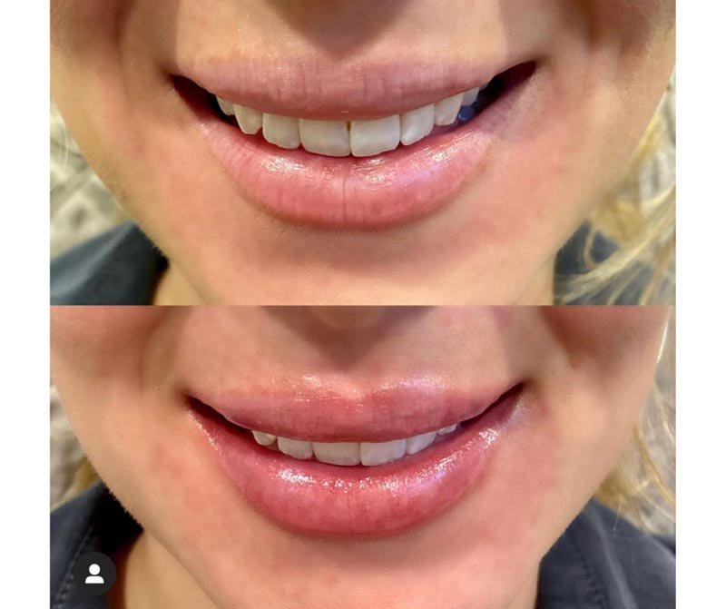 Restylane Kysse result — Bella Luce Med Spa
