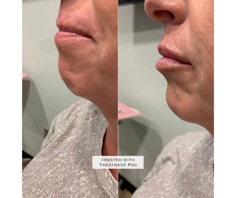 Juvederm Ultra Plus result — Bella Luce Med Spa