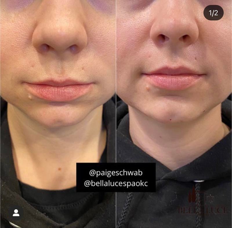 Chin Filler after — Bella Luce Med Spa