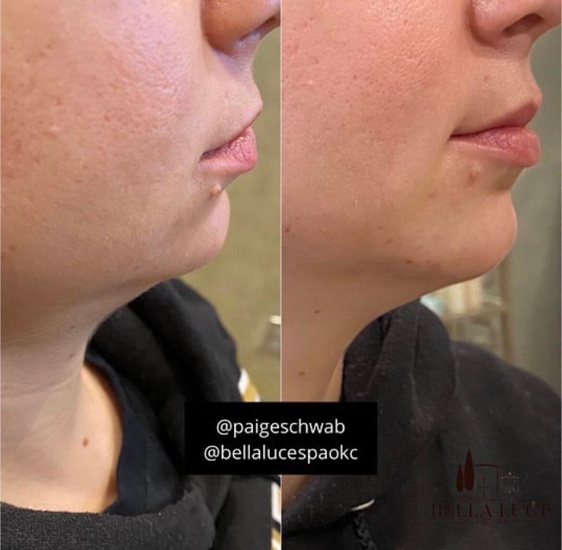 Chin Filler result — Bella Luce Med Spa