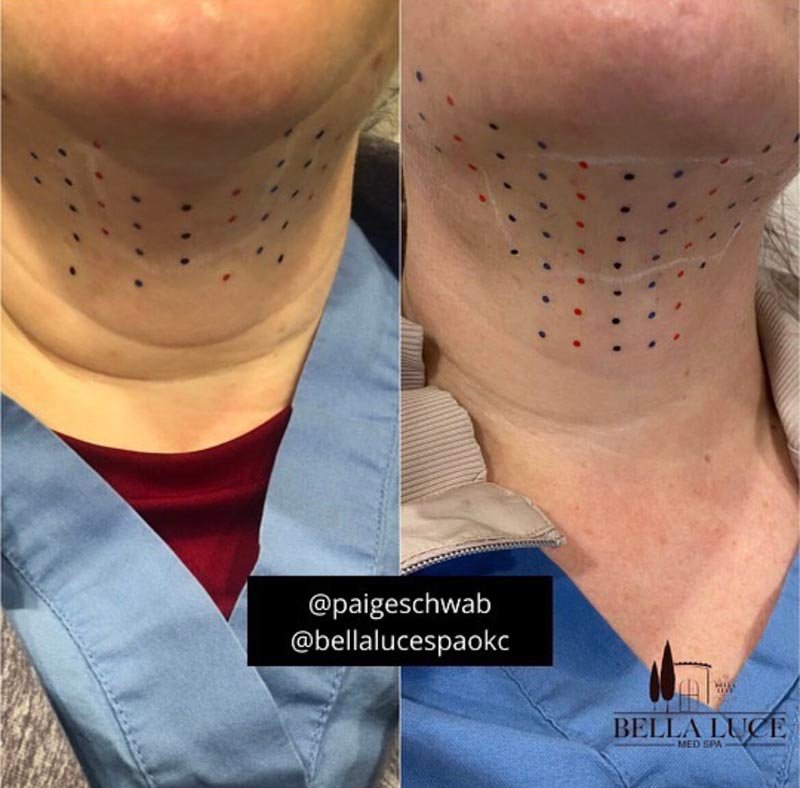 Kybella before — Bella Luce Med Spa