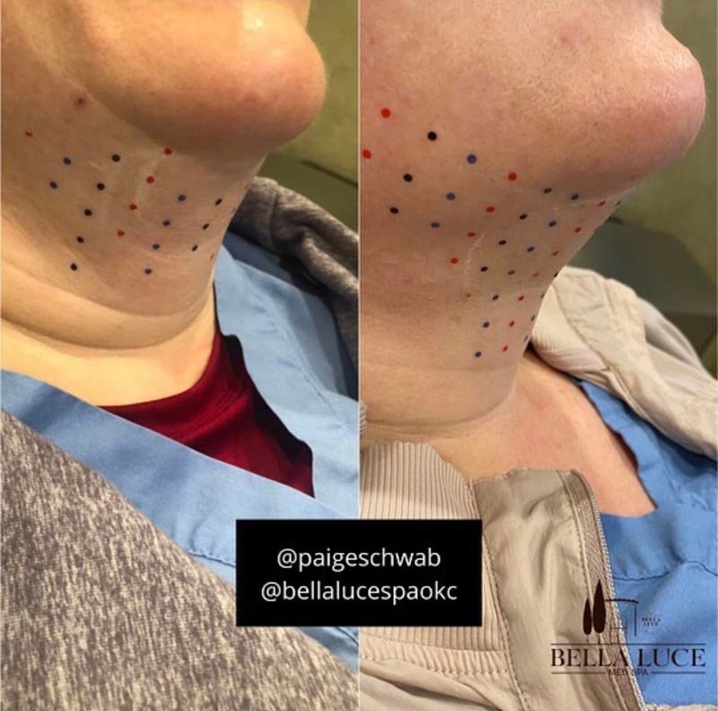 Kybella after 3rd treatment — Bella Luce Med Spa