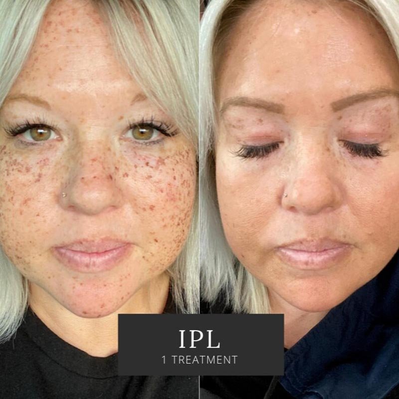 IPL Photofacial result — Bella Luce Med Spa
