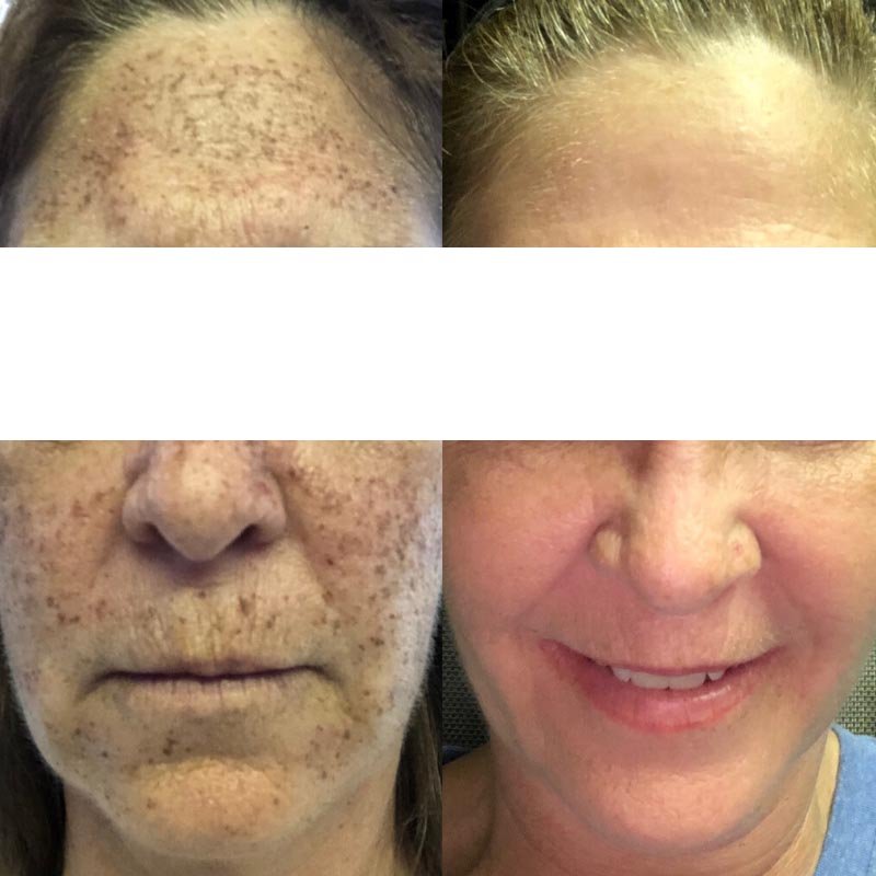 IPL Photofacial result — Bella Luce Med Spa