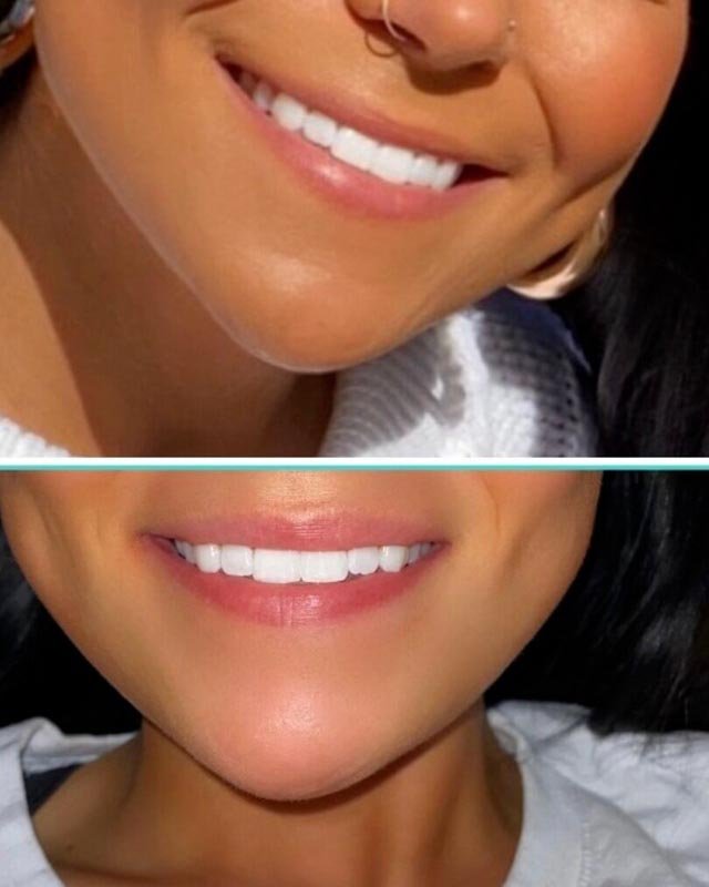 Lip Flip result — Bella Luce Med Spa