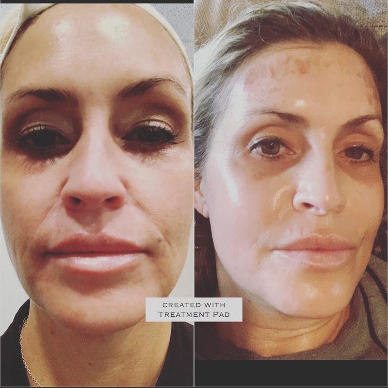 Pearl Skin Resurfacing result — Bella Luce Med Spa