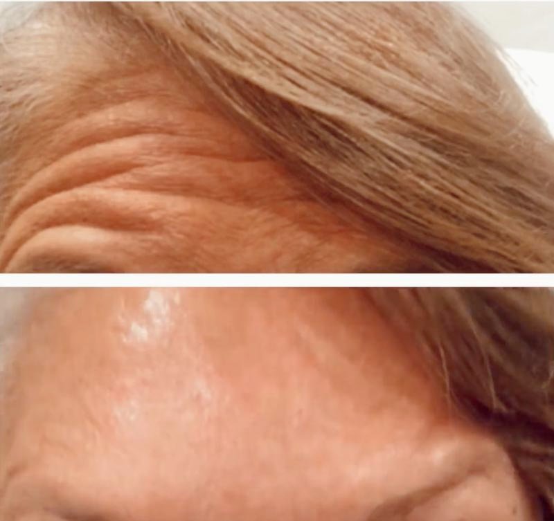 Botox result — Bella Luce Med Spa