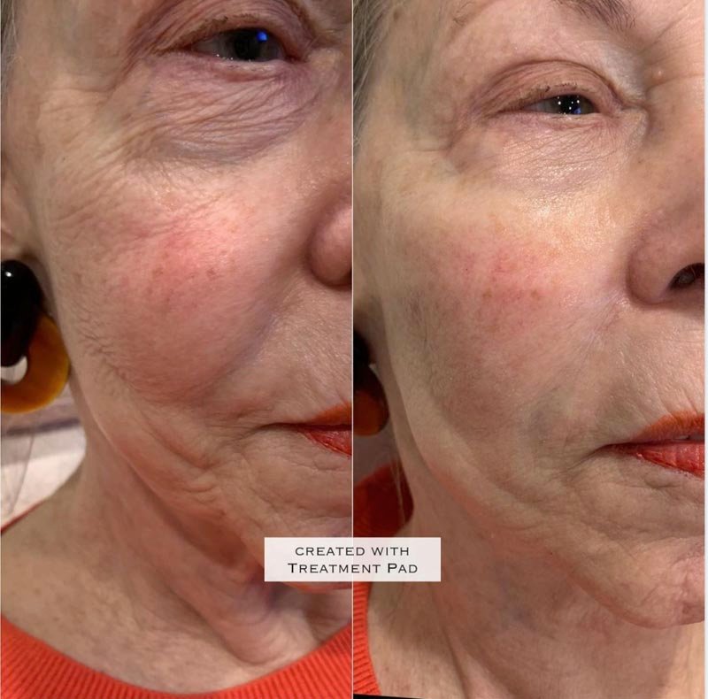 Botox result — Bella Luce Med Spa